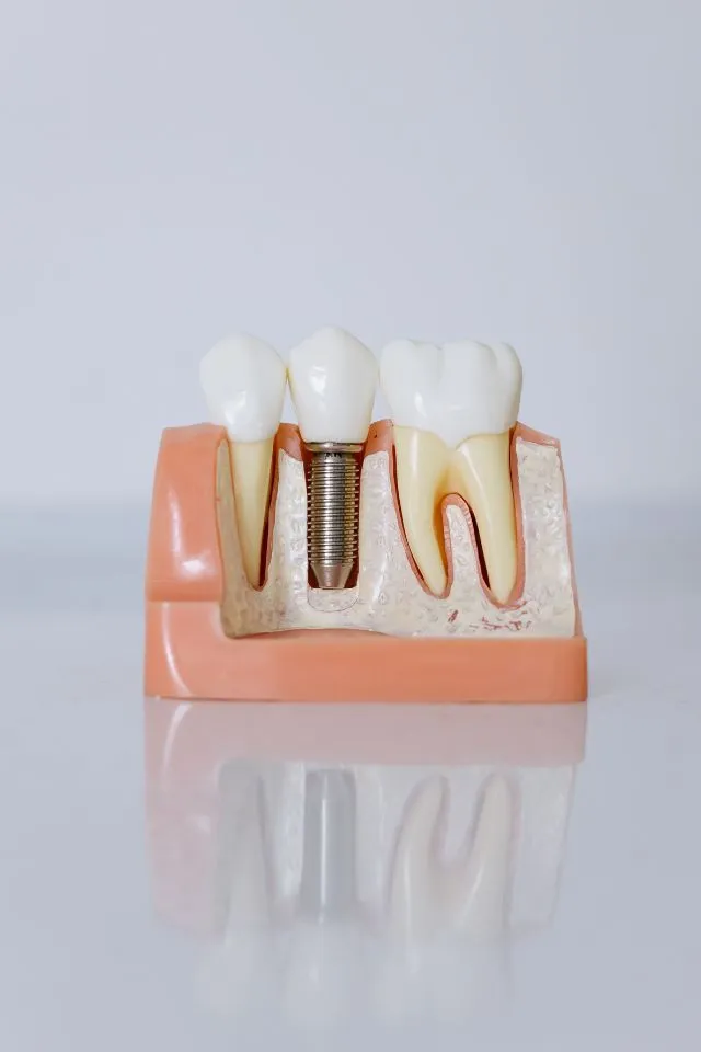 impianti dentali a catania